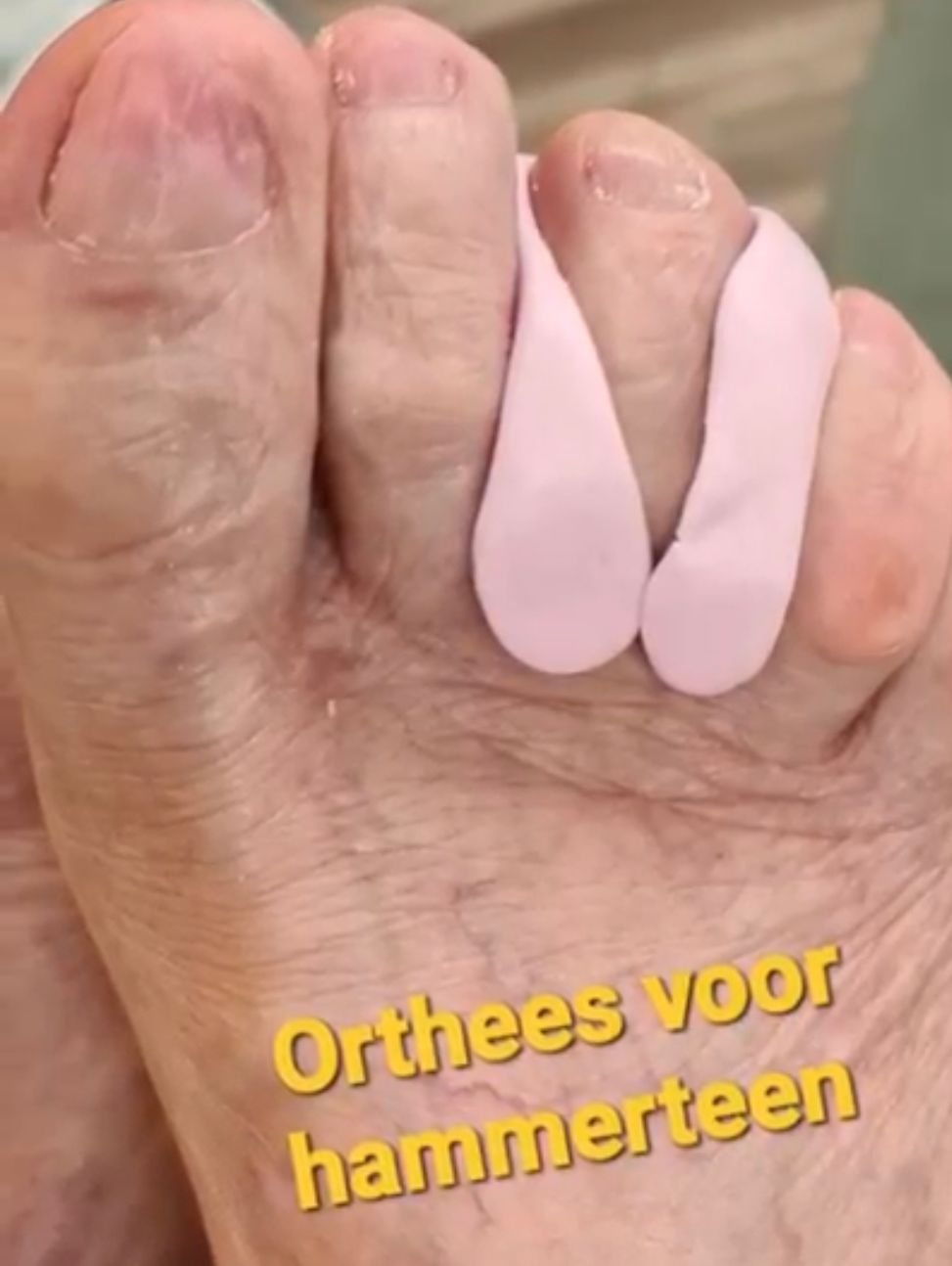 Ortheses
